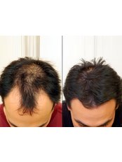 Hair Transplant - The Hair Loss Clinics - Carlisle