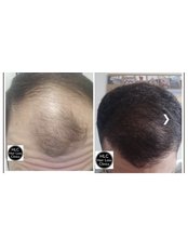 Hair Transplant - The Hair Loss Clinics - Carlisle