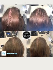 The Hair Loss Clinic - Exeter - 1 Barnfield Crescent, Exeter, EX1 1QT, 