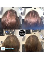 The Hair Loss Clinic - Exeter - 1 Barnfield Crescent, Exeter, EX1 1QT,  0