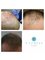 Tajmeel Clinic- Bournemouth, UK - hair transplant results after 6 months  