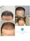 Tajmeel Clinic- Bournemouth, UK - hair transplant results at 4 and 9 months  
