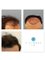 Tajmeel Clinic- Bournemouth, UK - hair transplant results at 6 months  