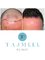 Tajmeel Clinic- Bournemouth, UK - hair transplant results at 8 months  