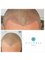 Tajmeel Clinic- Bournemouth, UK - SMP, results immediately after the procedure 