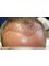 Tajmeel Clinic- Bournemouth, UK - Hair transplant immediately after surgery  