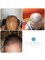 Tajmeel Clinic- Bournemouth, UK - hair transplant results at 14 weeks. 