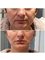 Tajmeel Clinic- Bournemouth, UK - three lift PDO, before and after 
