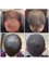 Capital Hair Restoration - Brighton - Capital Hair Restoration Programme 