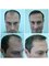 Capital Hair Restoration - Essex - 2500 Graft FUT Procedure 