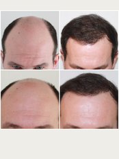 Capital Hair Restoration - Essex - Male Hair Transplant