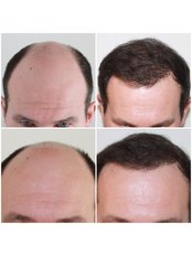 Capital Hair Restoration - Essex - Male Hair Transplant 