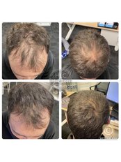 Laser Hair Therapy - Hair Loss Clinic - Essex - Epping