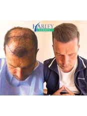 Hair Loss Specialist Consultation - Glasgow Hair Transplant Clinics