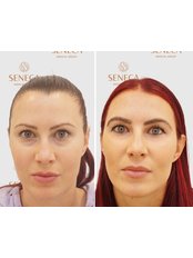 Eyebrow Transplant - Seneca Hair Transplant - UK