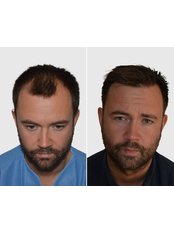 Direct FUE Hair Transplant - Seneca Hair Transplant - UK