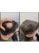 Hair Loss Clinic - Bolton - Alopecia Treatment 