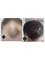 Hair Loss Clinic - Bolton - Hair Transplant 