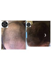 FUE - Follicular Unit Extraction - The Hair Loss Clinics - Lancaster