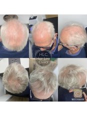 Hair Loss Specialist Consultation - The Hair Loss Clinics - Lancaster