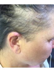 Treatment for Female Pattern Hair Loss - The Hair Loss Clinics - Lancaster
