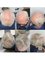 The Stockport Hair Loss Clinic - HLC Laser Treatment 