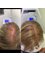 The Stockport Hair Loss Clinic - Cheadle Place, Stockport Road, Stockport, Cheshire, SK8 2JX,  22
