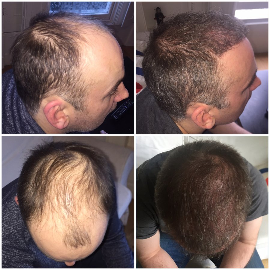 Capital Hair Restoration - Manchester in Manchester city center