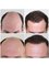 Capital Hair Restoration - Manchester - Male Hair Transplant 