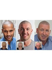 Hair Loss Treatment for thinning hair and male pattern baldness - Skalp - Manchester