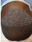 Surgery Group Ltd Manchester - Afro Hair Transplant 