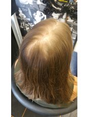 Hair Loss Specialist  - Capelli Remi