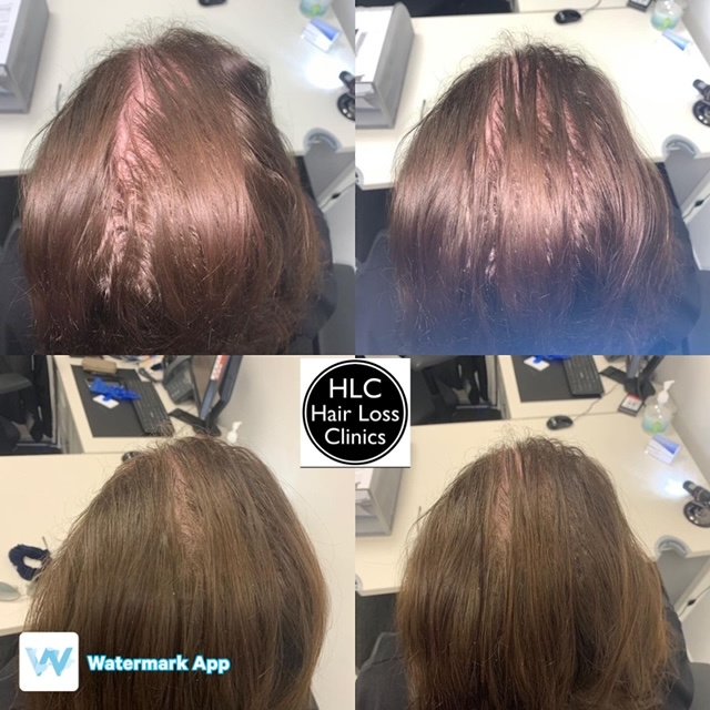 Hair Loss Clinic - Essex -  Brentwood