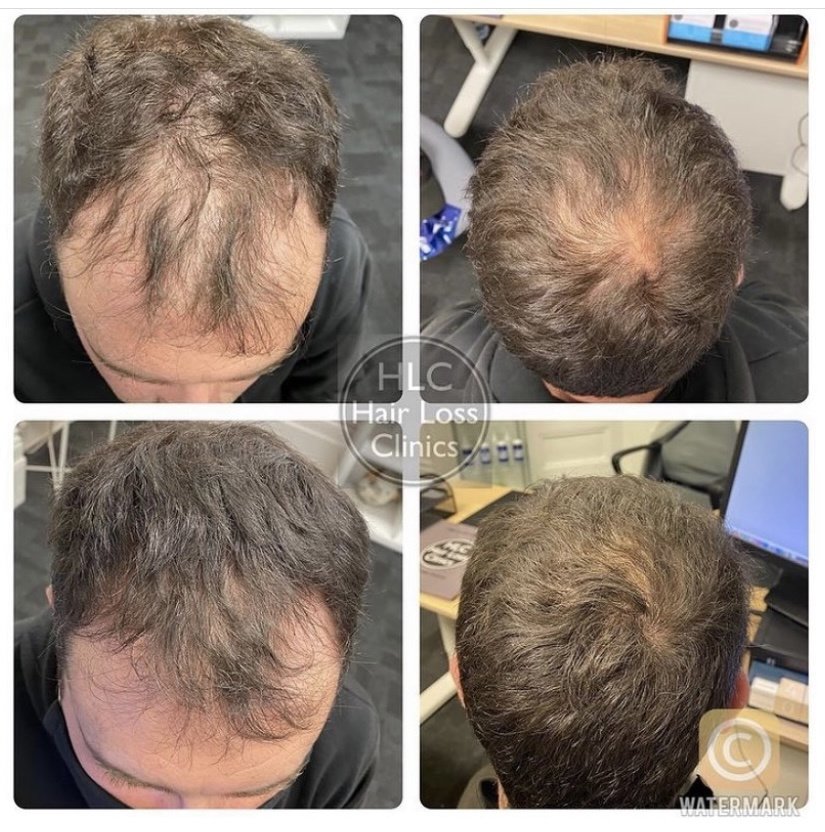Preston Hair Loss Clinic • Read 5 Reviews
