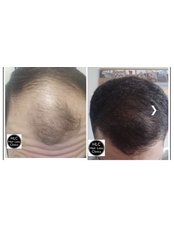FUE - Follicular Unit Extraction - Preston Hair Loss Clinic