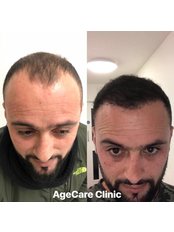 Hair Transplant - Age Care Clinic