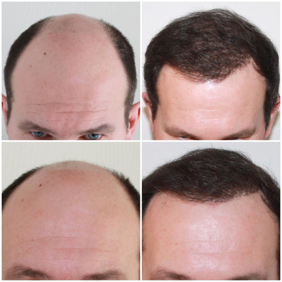 Capital Hair Restoration - Kent
