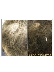 FUE - Follicular Unit Extraction - Hair Loss Clinic - Bromley