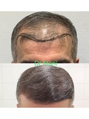 FUE - Follicular Unit Extraction - Dr Manish Mittal Hair Transplant Clinic