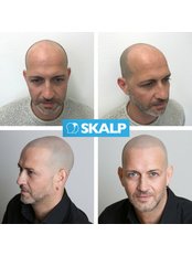Hair Loss Treatment for thinning hair and male pattern baldness - Skalp - London