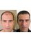 Get Hair -  Hair Transplant Professionals - Before/After 3200 Grafts 