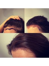 Female Forehead Reduction - Harris Hair Transplant UK