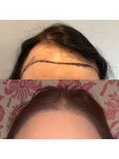 Female Forehead Reduction - Harris Hair Transplant UK