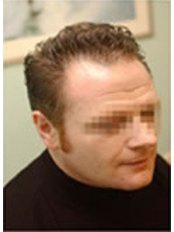 Hair Loss Treatment - Preston Hair Loss Clinic - Stoke on Trent