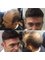 Preston Hair Loss Clinic - Stoke on Trent - Hair System 