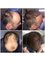 Capital Hair Restoration - Surrey - 3500 Graft FUE Procedure 