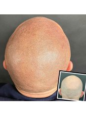SMP treatment for alopecia totals/ universal - Scalp Doctor