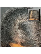 SMP Treatment for Female Pattern Hair Loss - Scalp Doctor