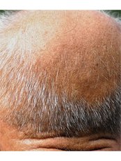 Natural Treatment for Male Pattern Baldness - New Man Clinic