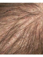 Telogen Hair Loss (Telogen Effluvium) Treatment - New Man Clinic
